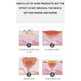 Dr. Rashel Aloe Vera Anti-Acne Pimple Cream Repair Acne Scars